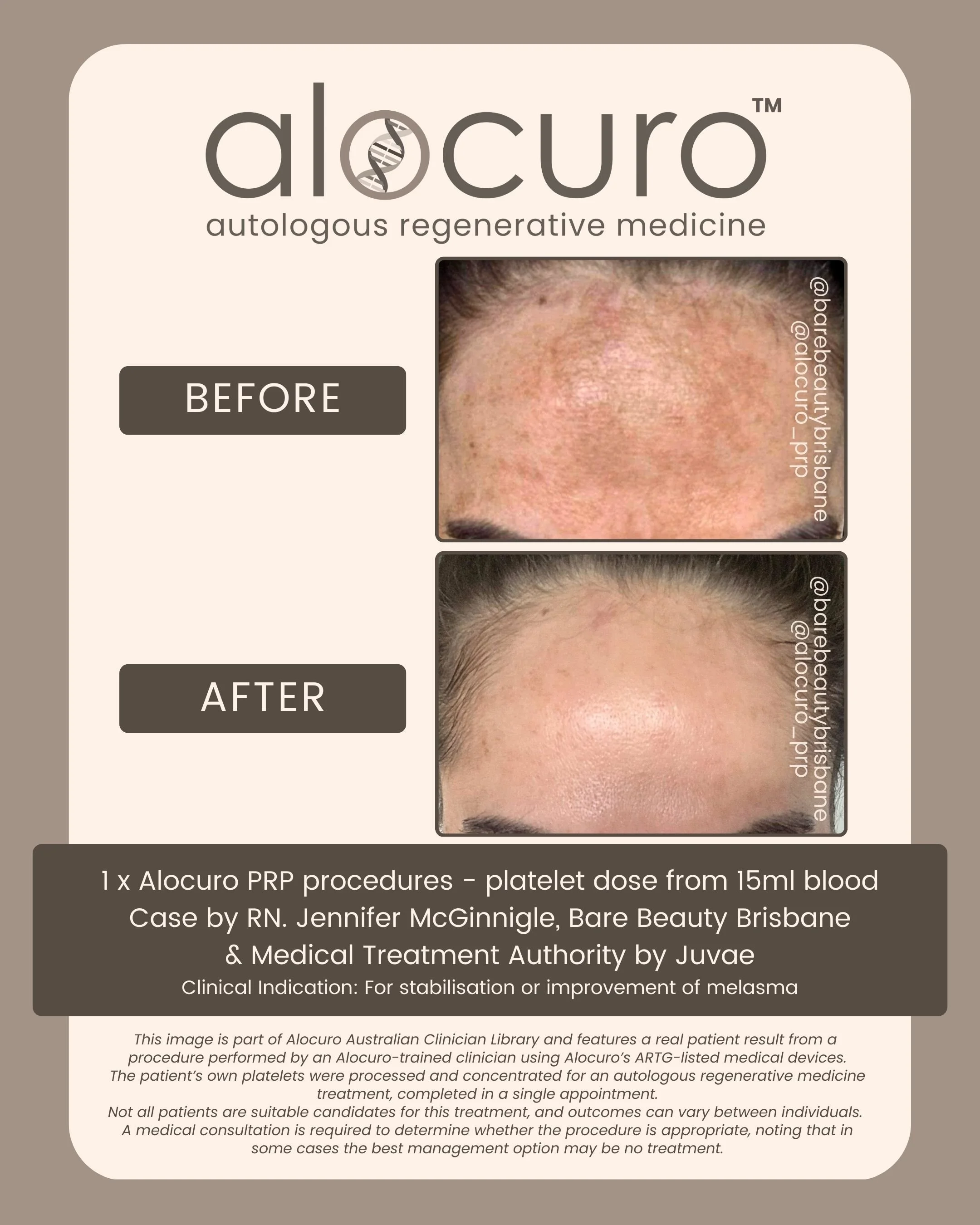 Alocuro Skin Case PRP - Before & After - 24.jpg