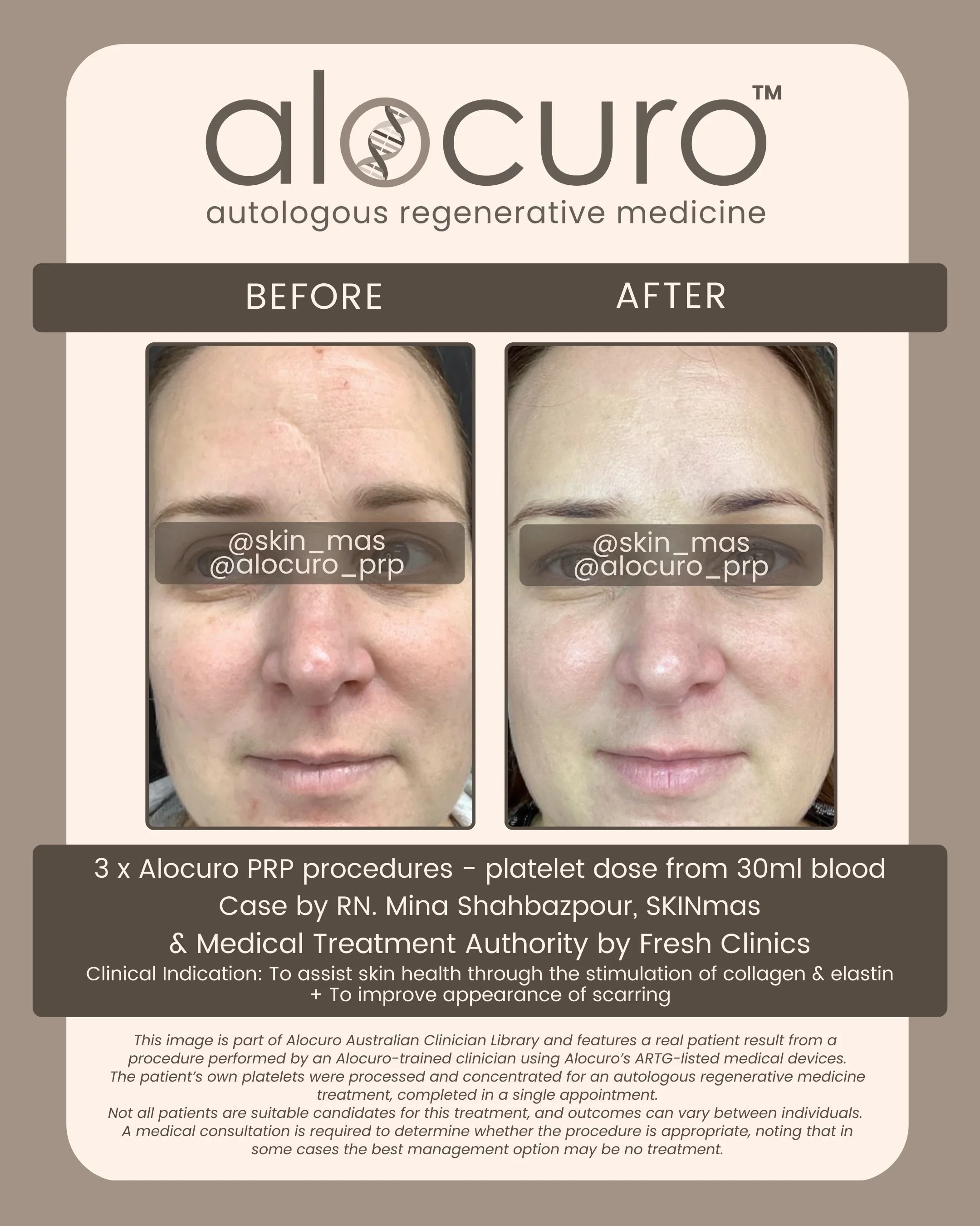 Alocuro Skin Case PRP - Before & After - 25.jpg