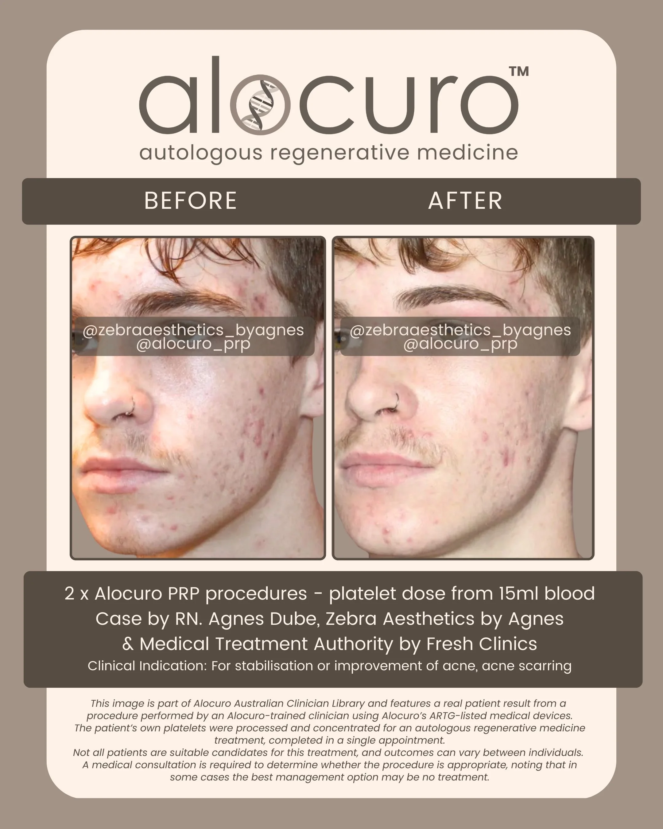 Alocuro Skin Case PRP - Before & After - 39.jpg