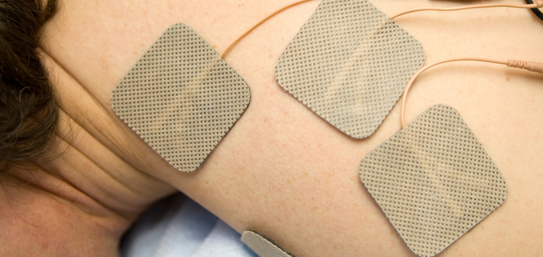 Mit sau realitate: electroterapia poate cauza arsuri