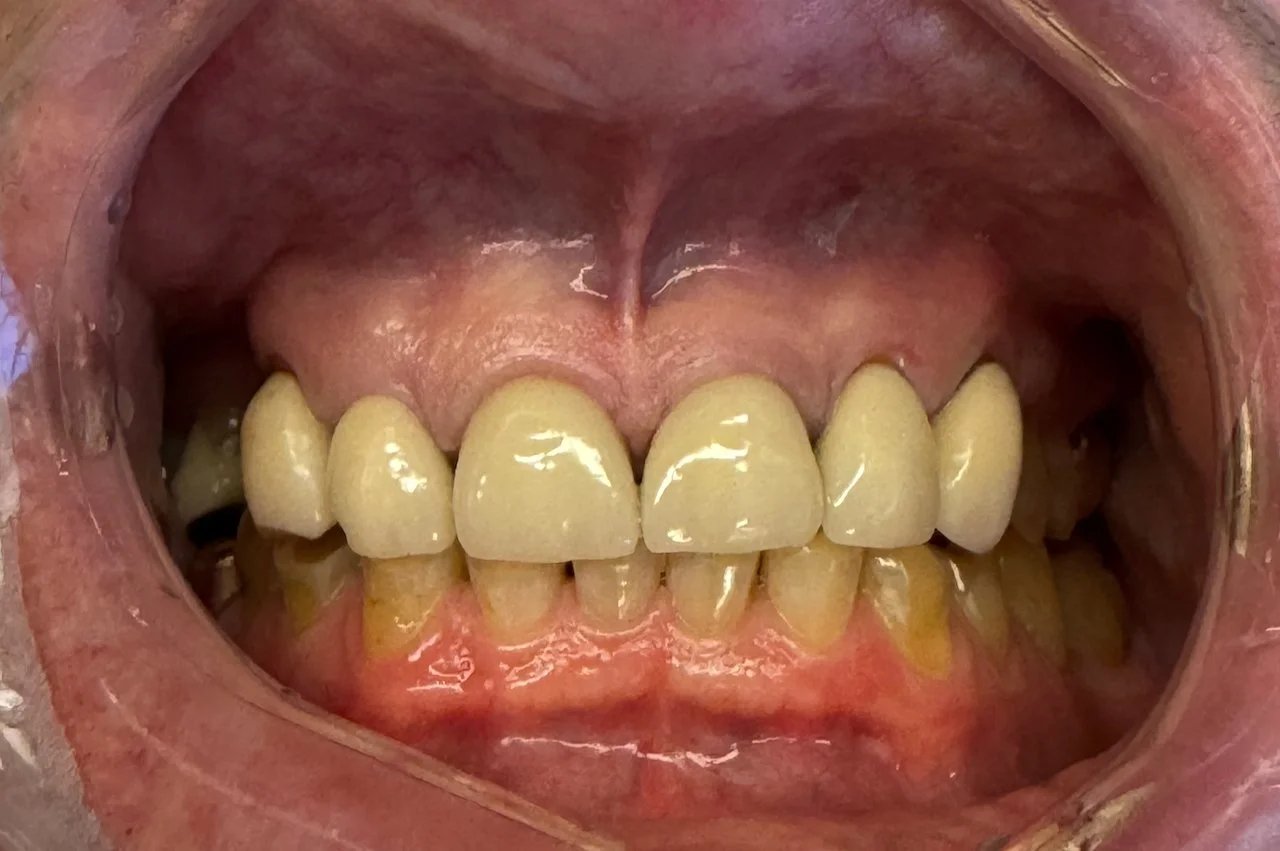 Close-up of dried, discolored, and uneven teeth inside an open mouth, with visible plaque and dental crowding.