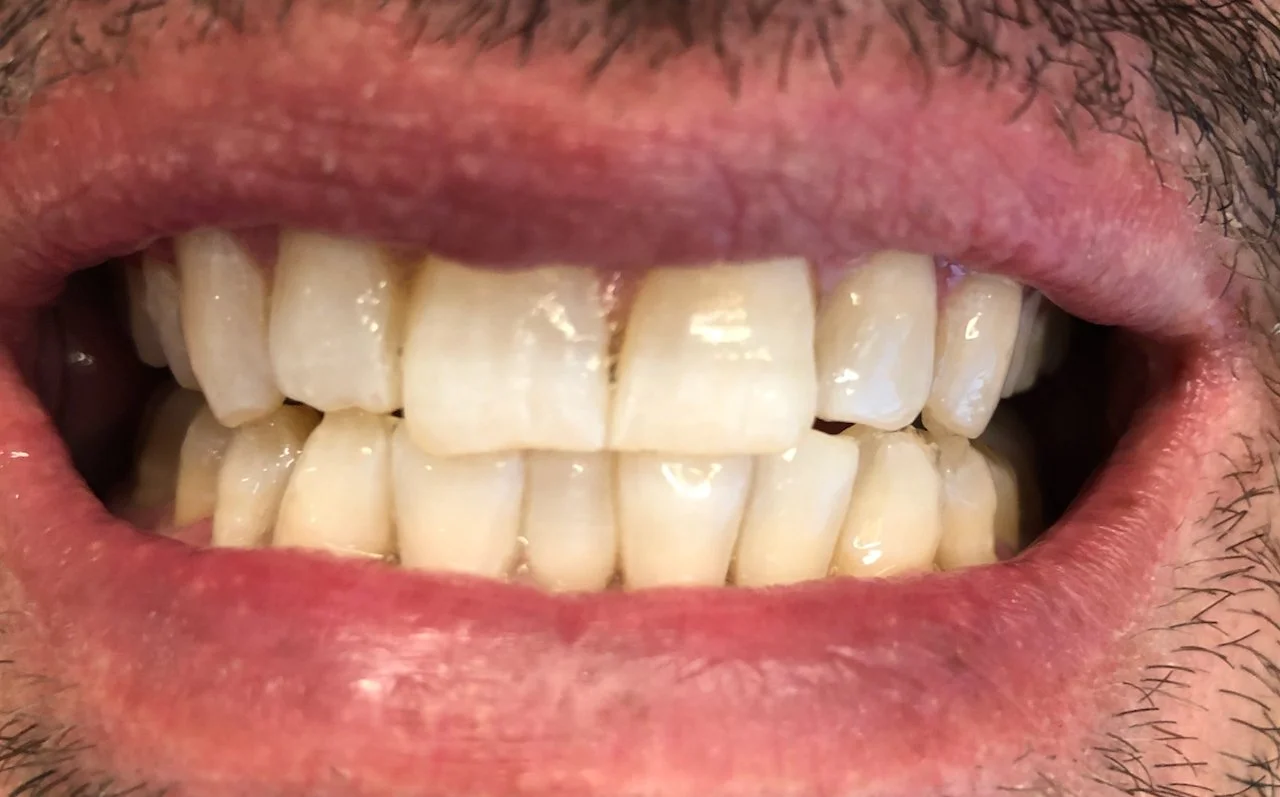 Close-up of a person's open mouth showing yellowed, stained teeth with uneven edges and some plaque buildup.