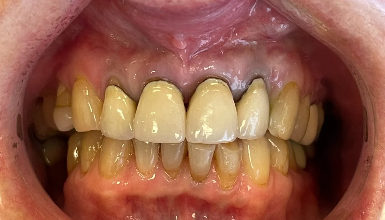 Close-up image of a person's mouth showing yellowed, stained, and crooked teeth with visible plaque.