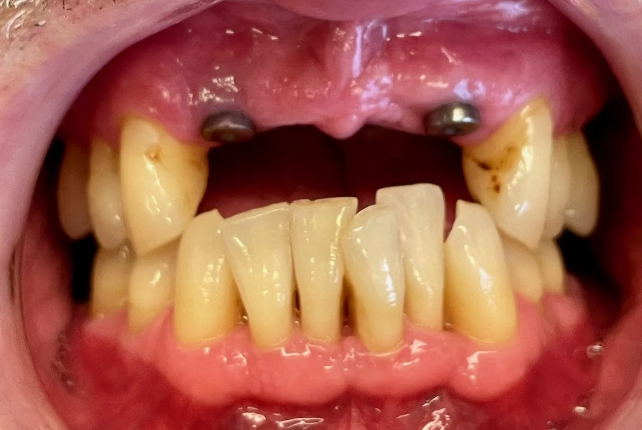 A close-up of a person's mouth showing severe tooth decay, missing teeth, and dental implants on upper gums.