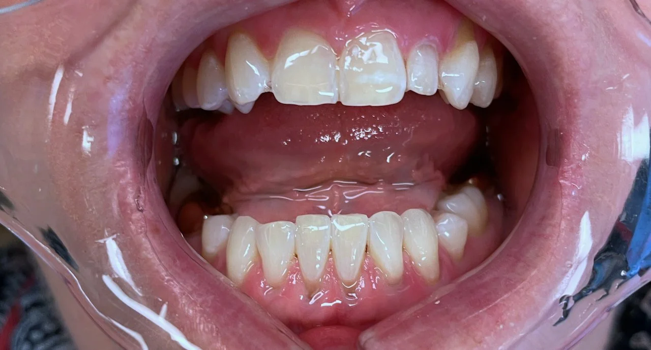 Open mouth with visible upper and lower teeth, some discoloration, and signs of dental decay.