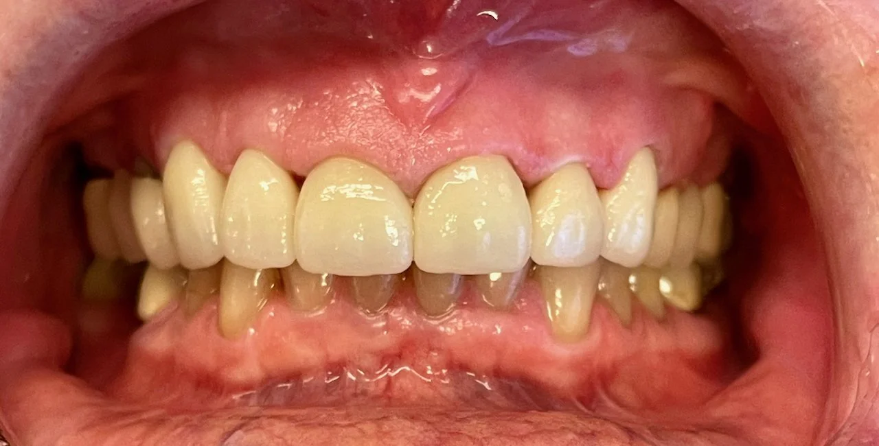 Close-up of a person's mouth showing teeth with discoloration, misalignment, and plaque buildup.