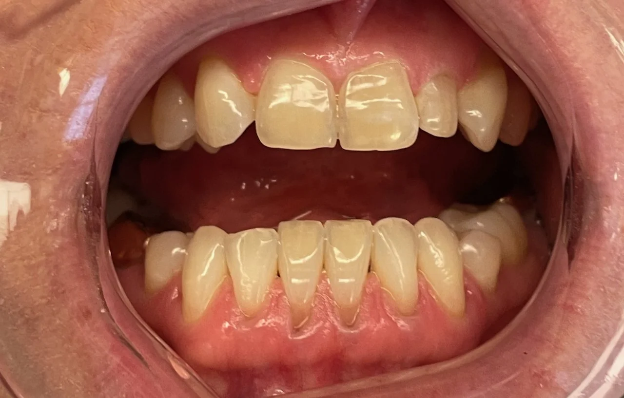Open mouth showing upper and lower front teeth with slight discoloration and wear.