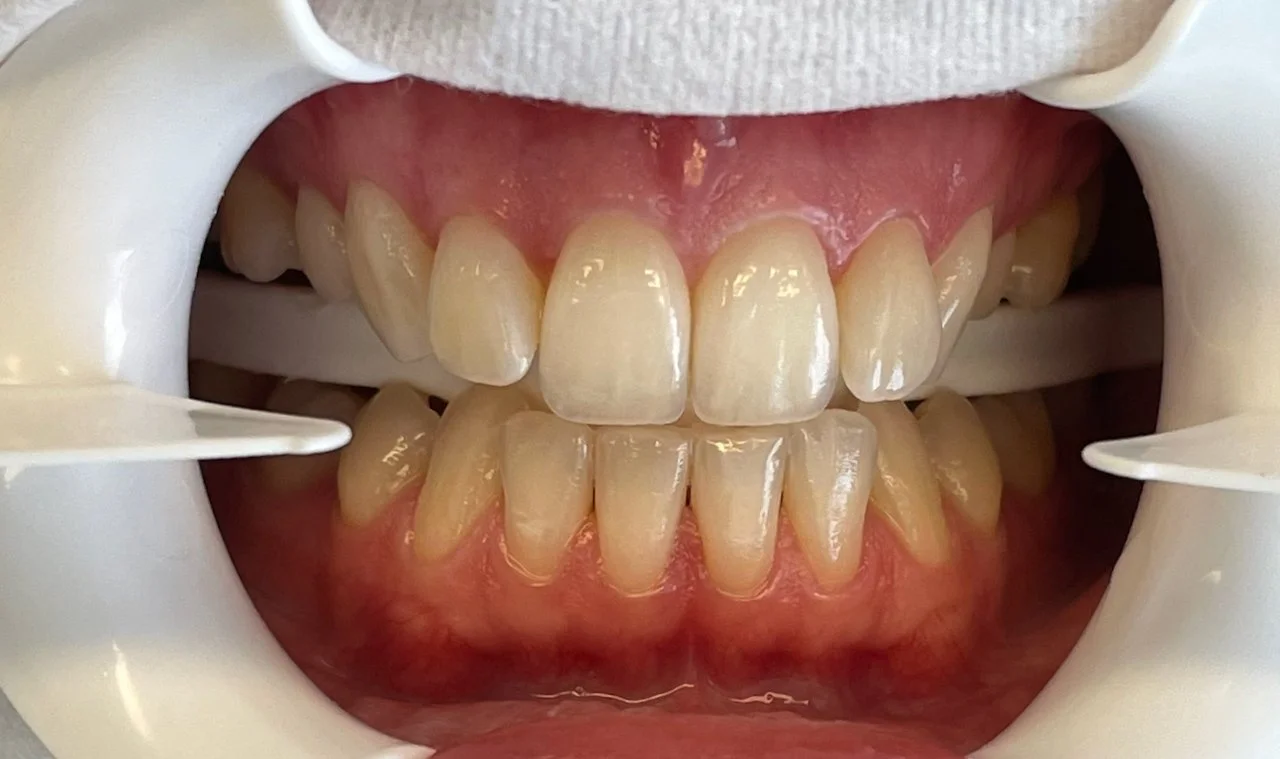 Close-up of teeth with dental cheek retractors showing upper and lower teeth, some with discoloration and signs of plaque.