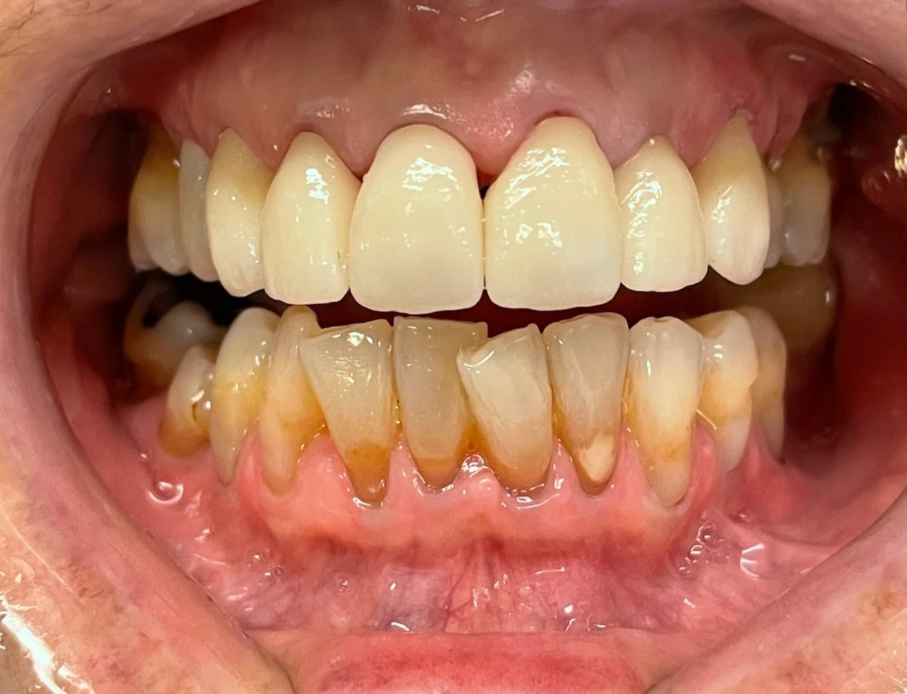 Close-up of a mouth showing upper and lower teeth, some with signs of discoloration, plaque buildup, and irregular alignment.