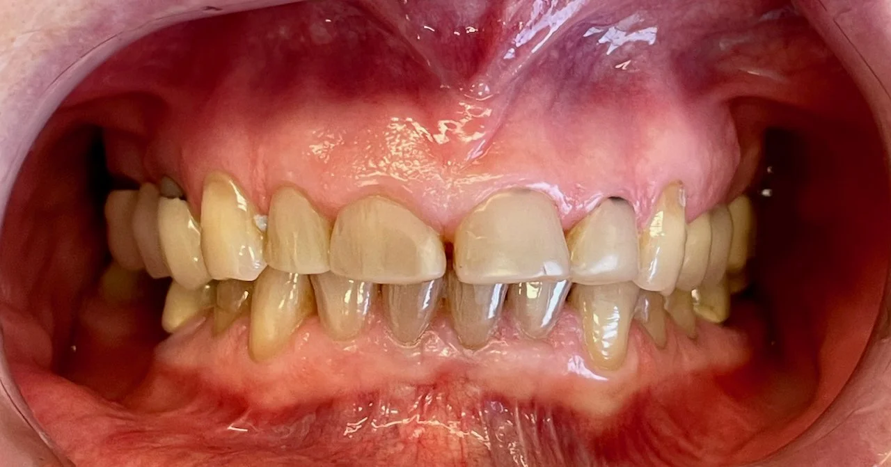 Close-up of teeth with visible staining, misalignment, and plaque buildup.