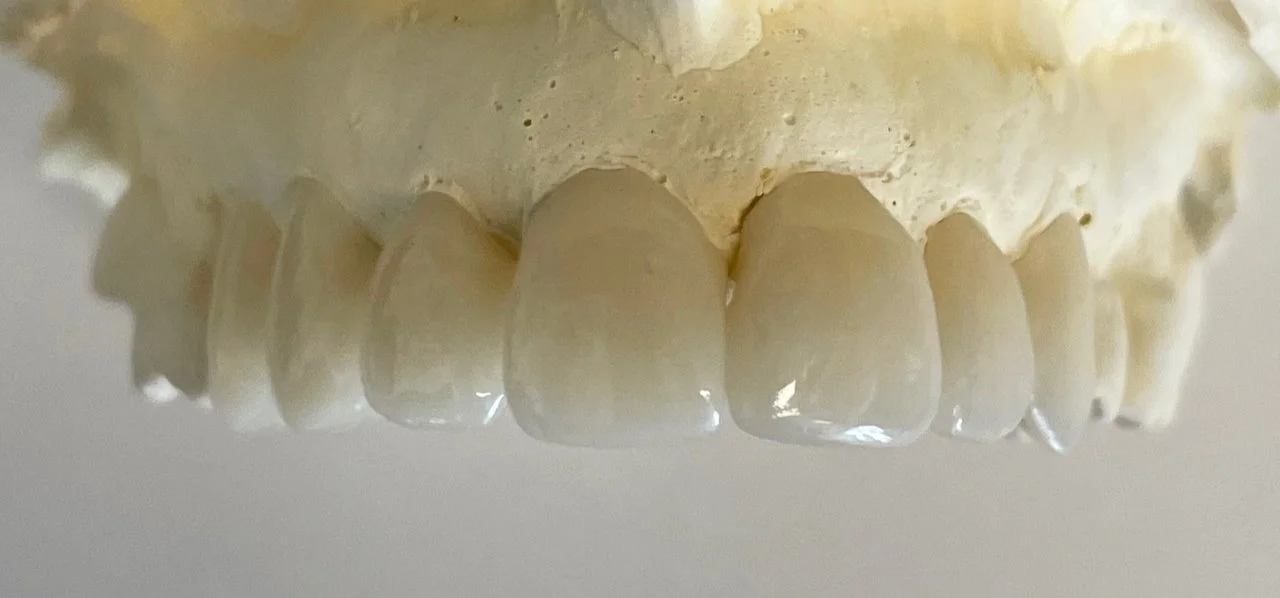 Upside-down view of a human skull showing the front teeth and upper jaw, with a focus on the teeth.