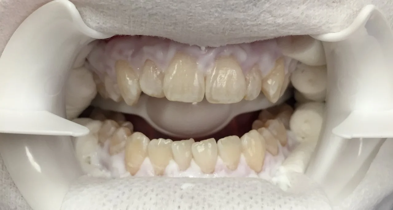 Close-up of a mouth with dental retractors, showing teeth stained yellow and discolored.