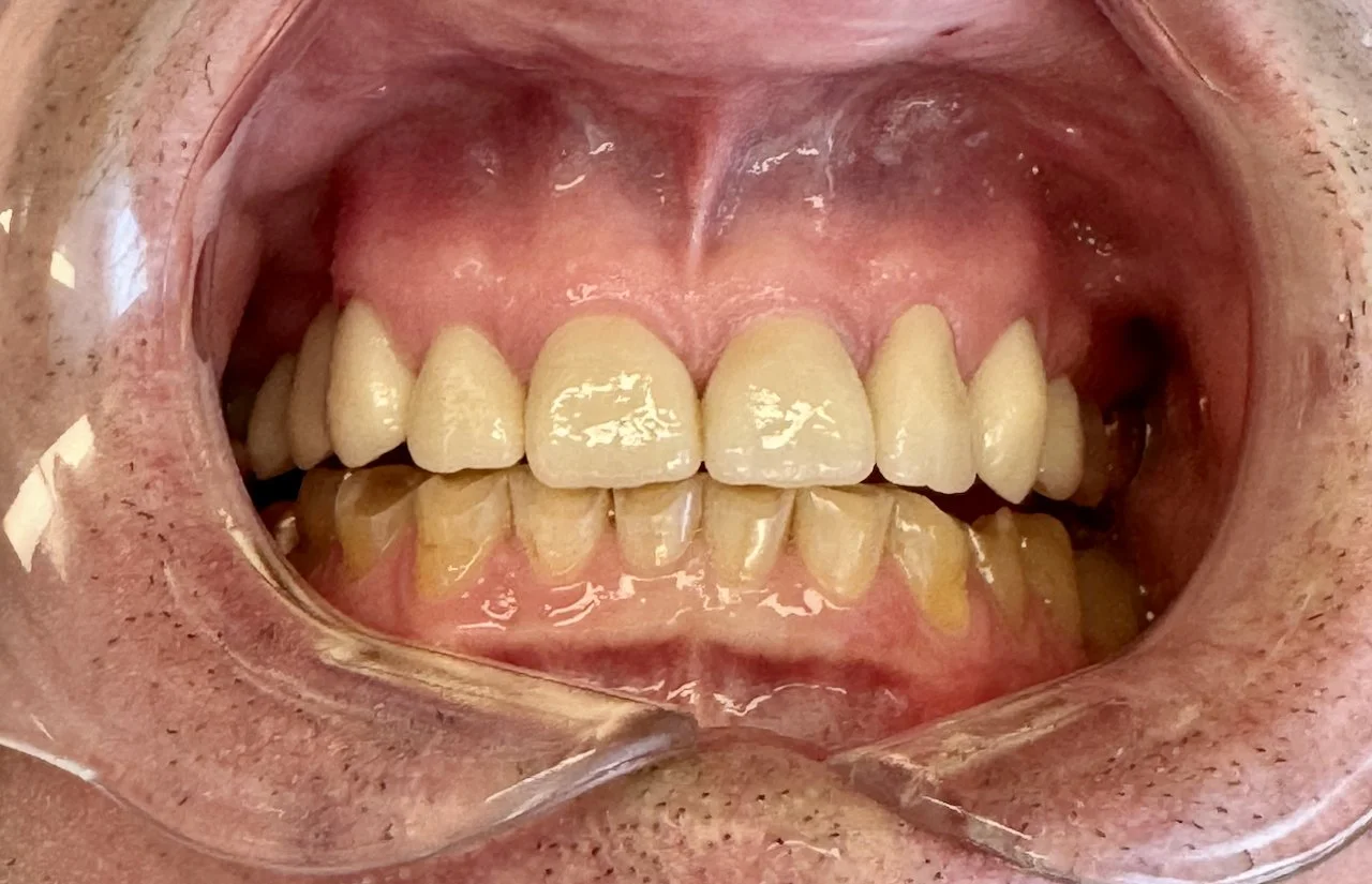Close-up of a person's open mouth showing upper and lower teeth, with some discoloration and plaque buildup.