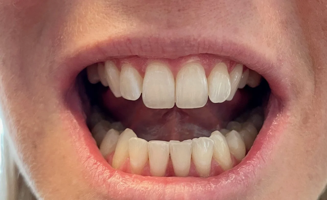 Close-up of a person's open mouth showing upper and lower teeth with visible dental crowding.