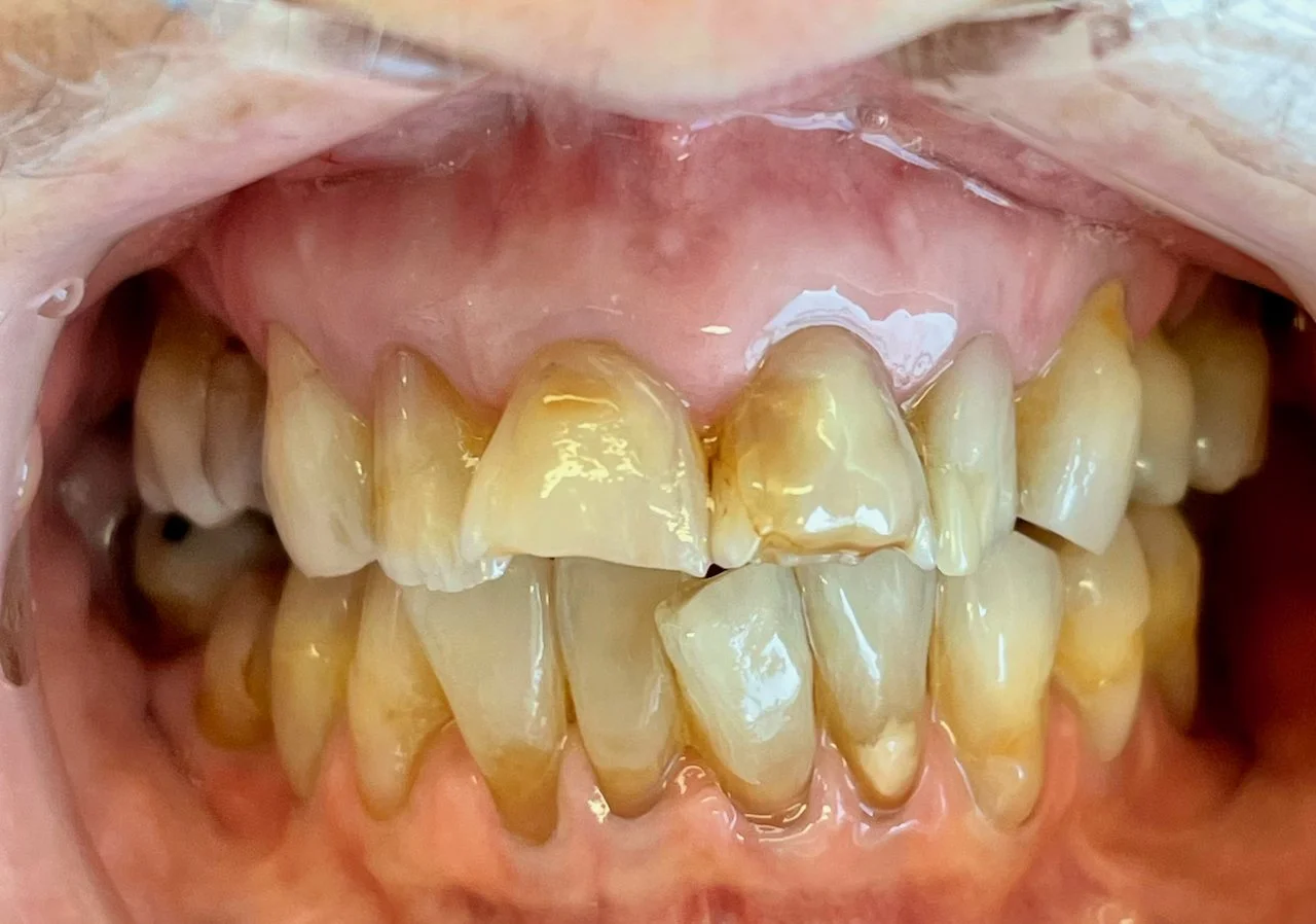 Close-up of stained, yellowed, and crooked teeth with plaque buildup in the mouth.