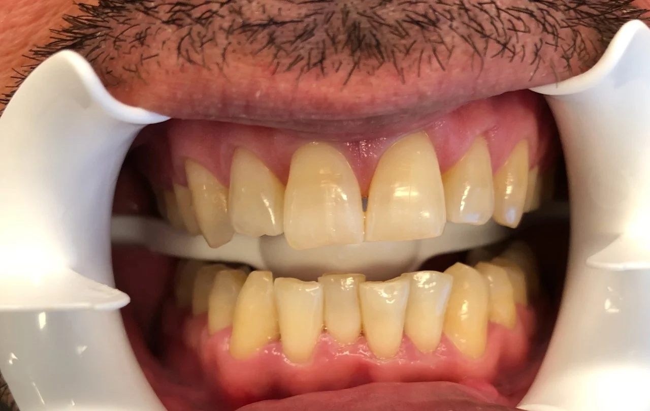 Close-up of a person's open mouth with a dental retractor, showing stained and crooked teeth, including upper and lower front teeth.