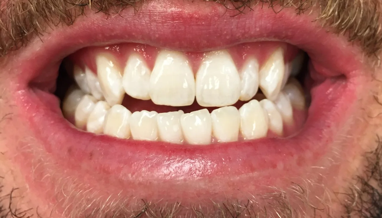 Close-up of a person's mouth showing slightly crooked upper and lower teeth with some gaps.