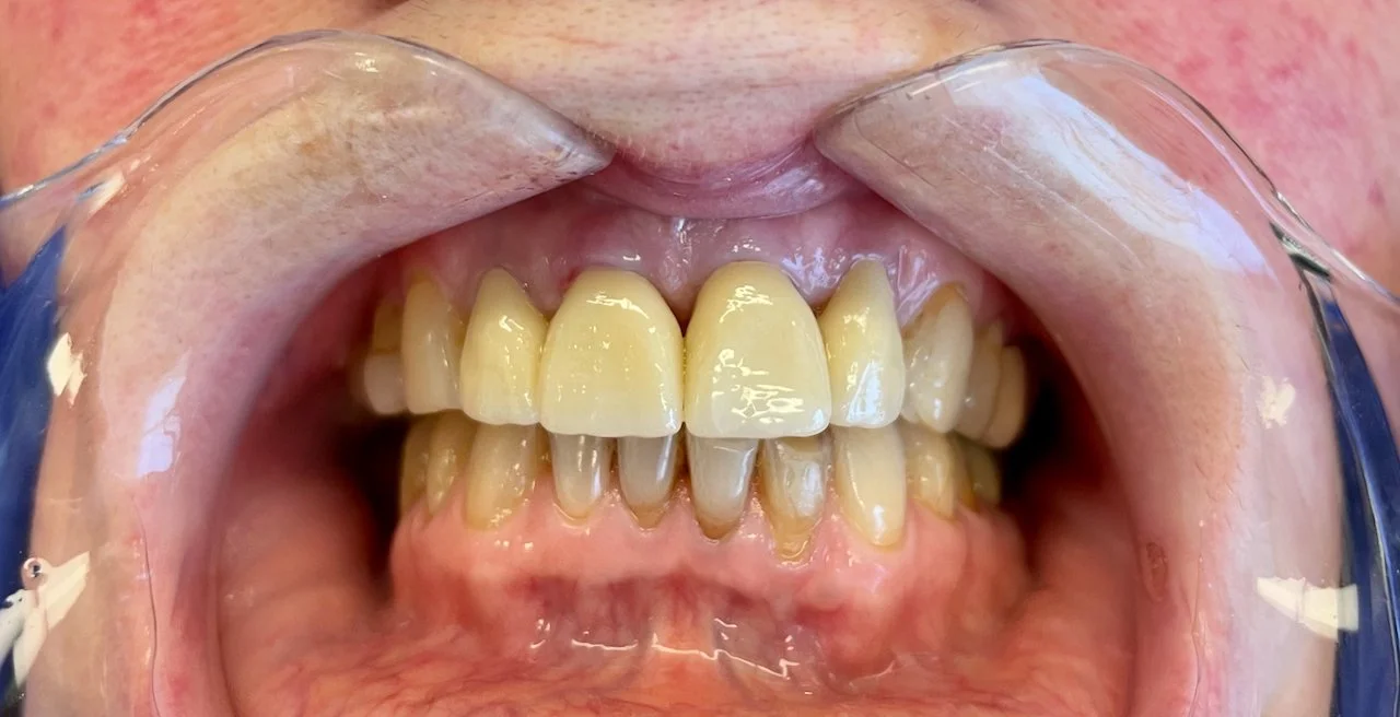 Close-up of a person's open mouth showing yellowed, stained, and uneven teeth with visible plaque and gingivitis.