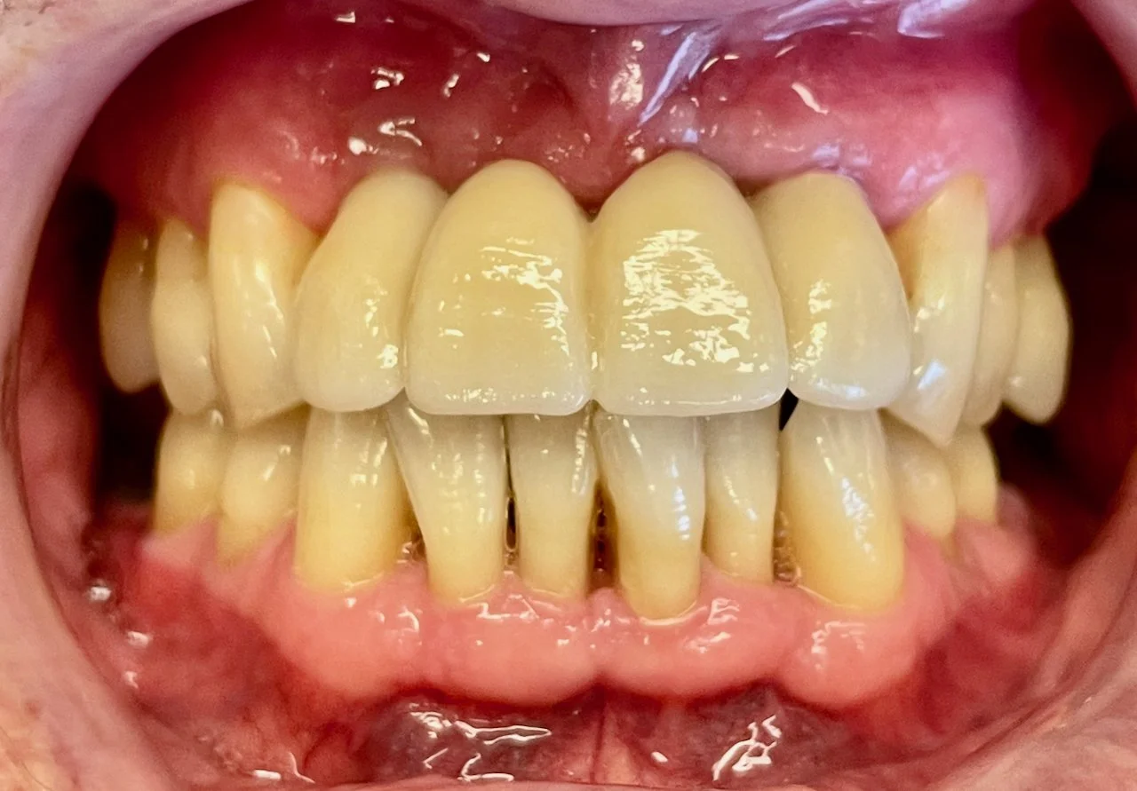 Close-up of a person's mouth showing yellowed and stained teeth with plaque buildup and gum inflammation.