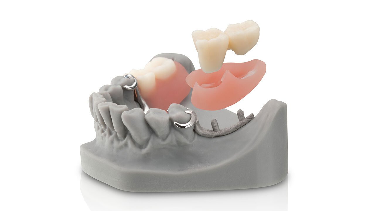 How Snap-On 3D Printed Teeth and Gingiva Are Revolutionizing Traditional Metal Partials