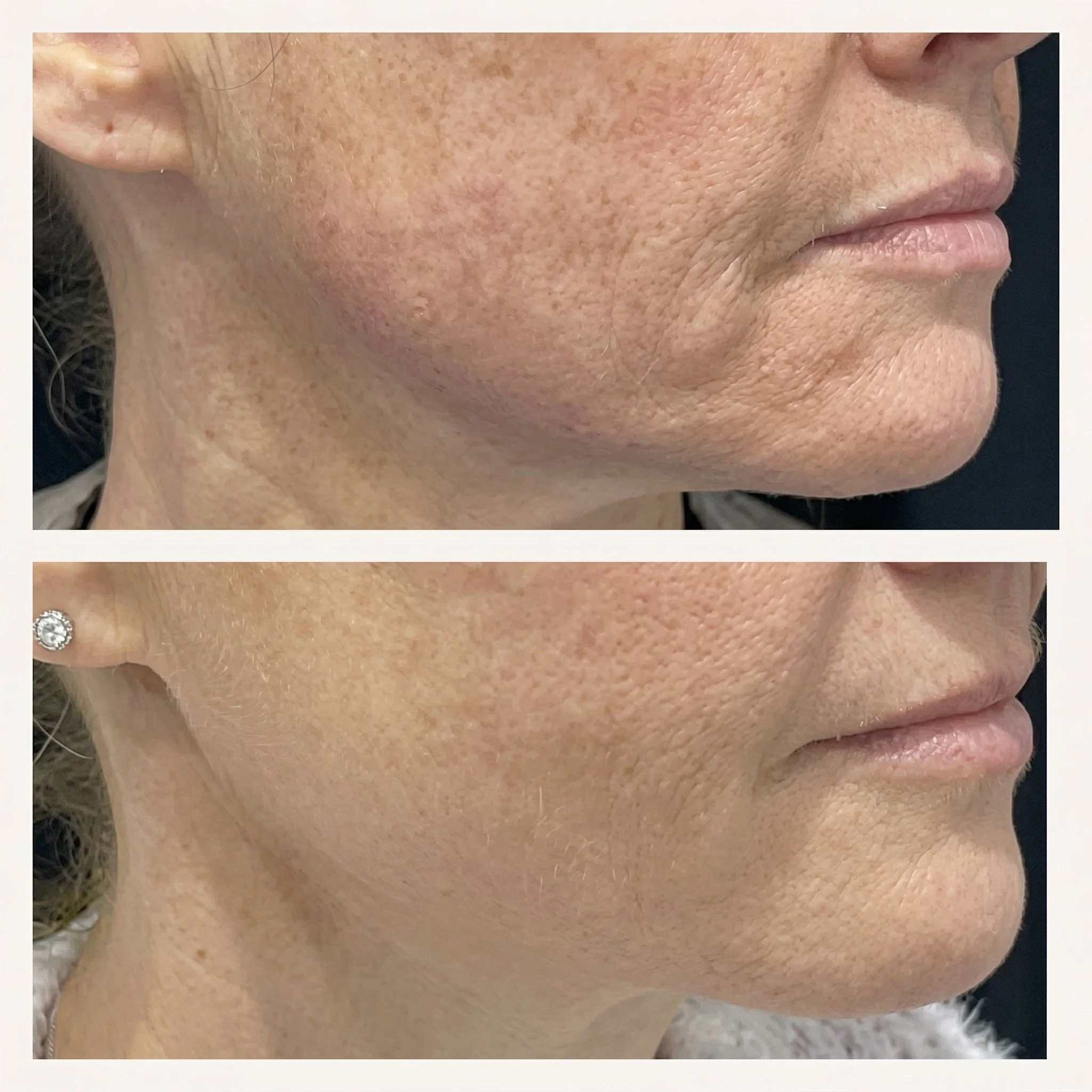 Comparaison avant et après traitement de la peau montrant une amélioration visible de la texture et des taches pigmentaires sur le visage.