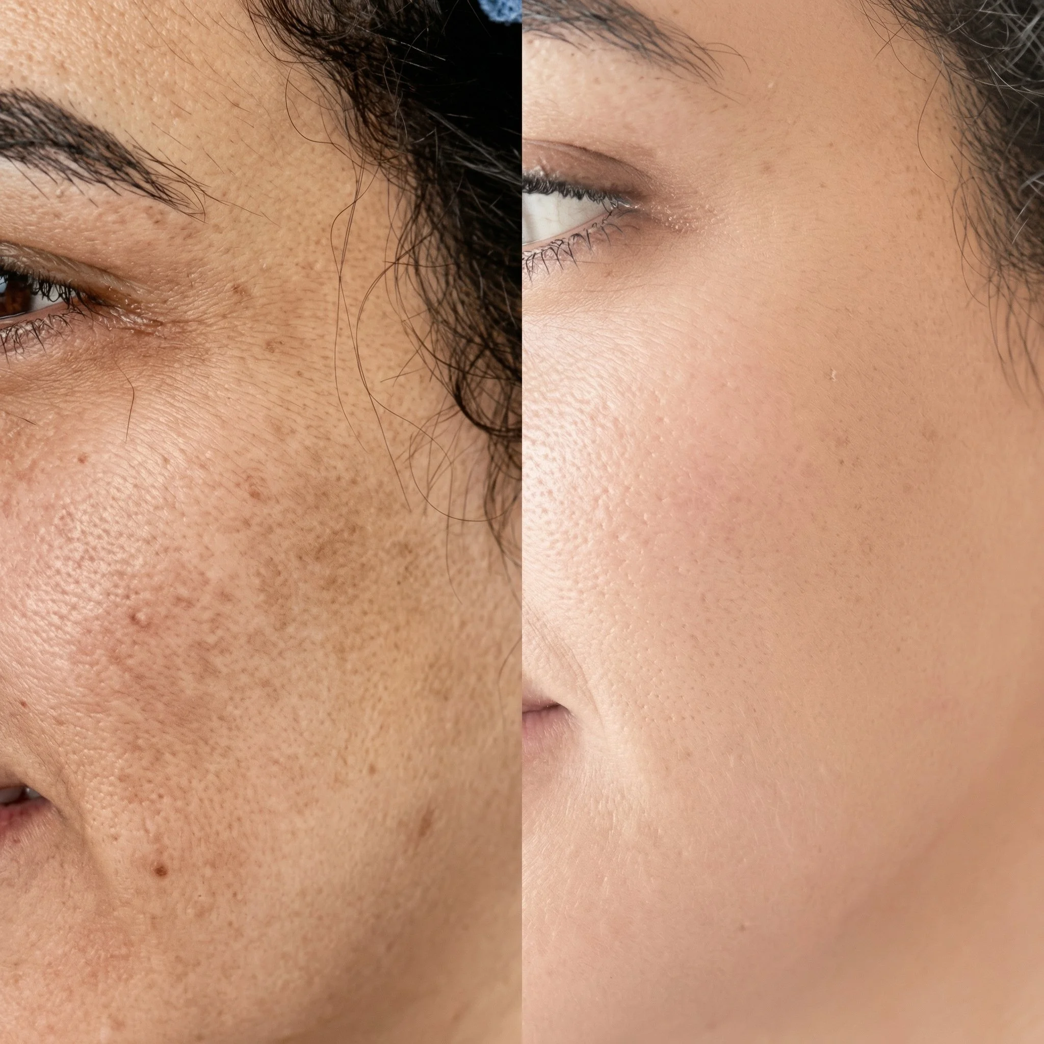 Comparaison de deux visages montrant une peau avec des imperfections sur la gauche et une peau claire, lisse et sans imperfections sur la droite.