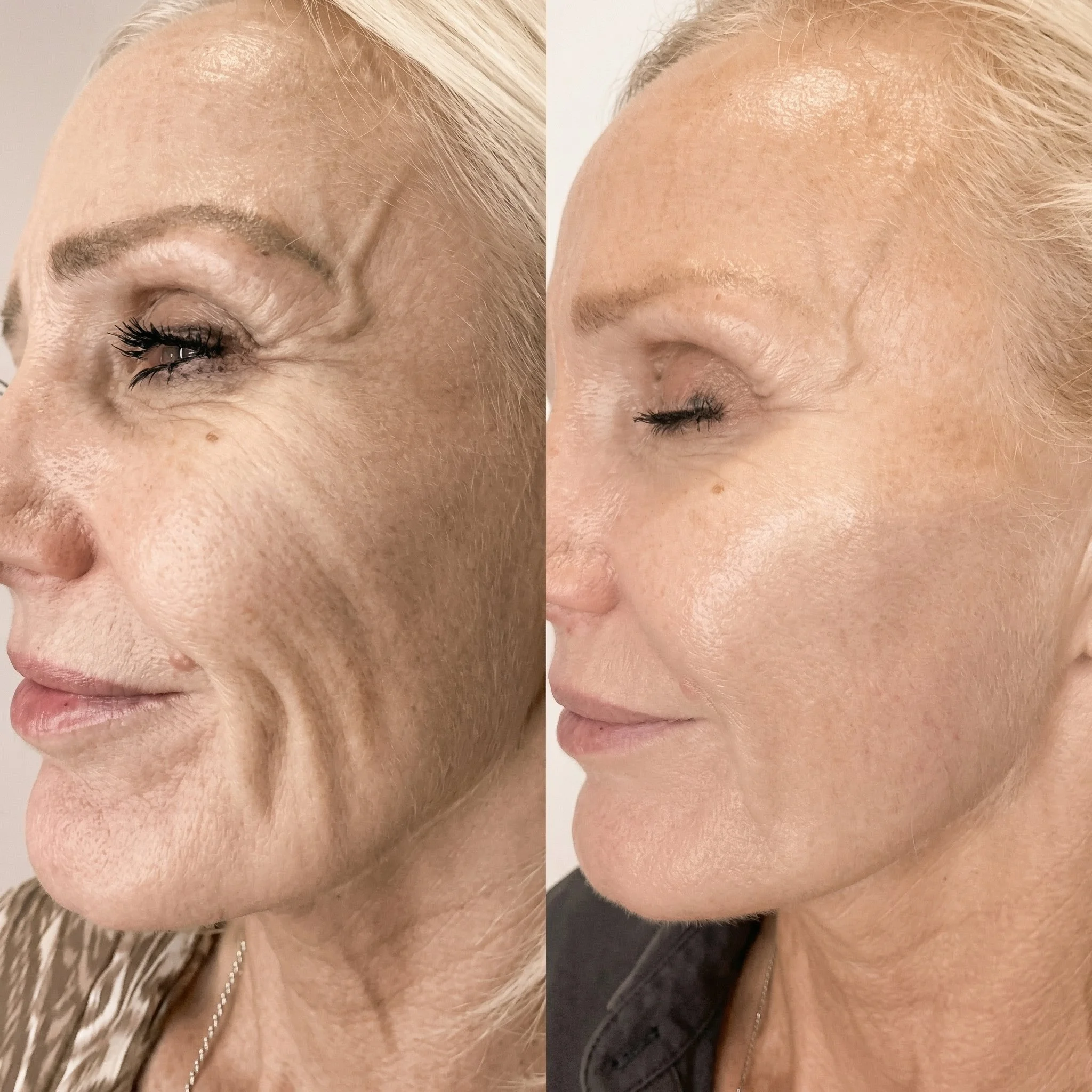 Comparaison de deux photos de profil d'une femme, montrant une amélioration de la texture de la peau, avec moins de rides et une peau plus lisse sur la photo de droite.
