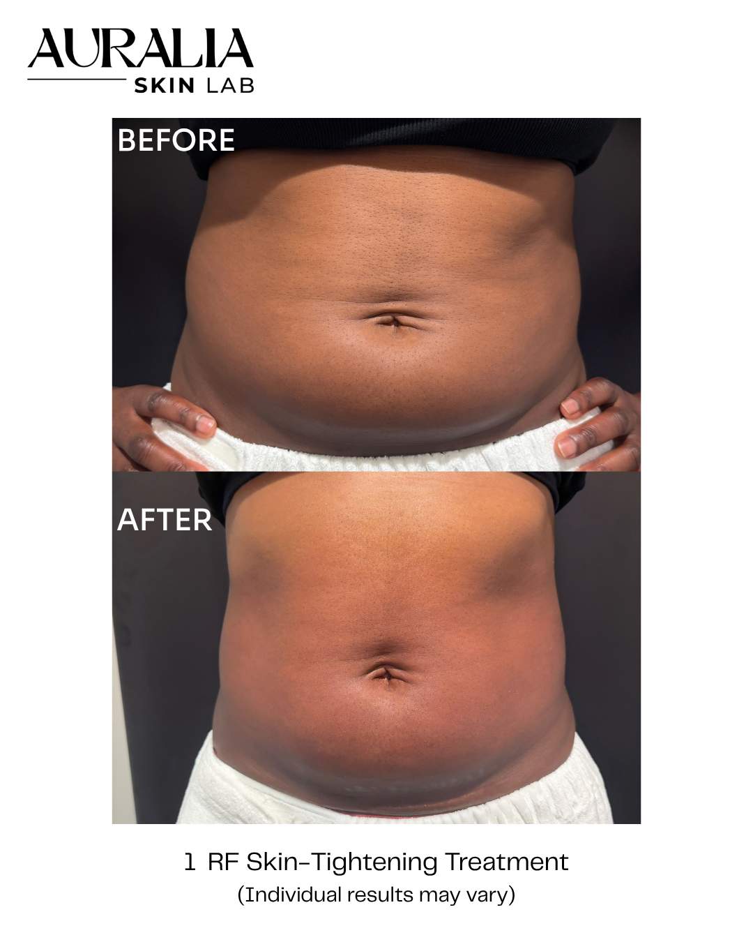 before and after photo of skin tightening