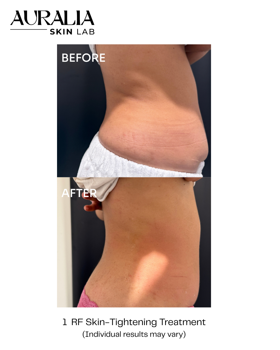 before and after photo of skin tightening, abdomen