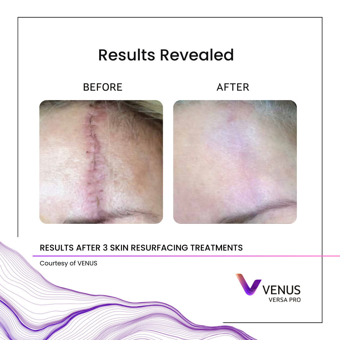 Before and after NanoFractional RF treatment showing improvement in the appearance of a scar