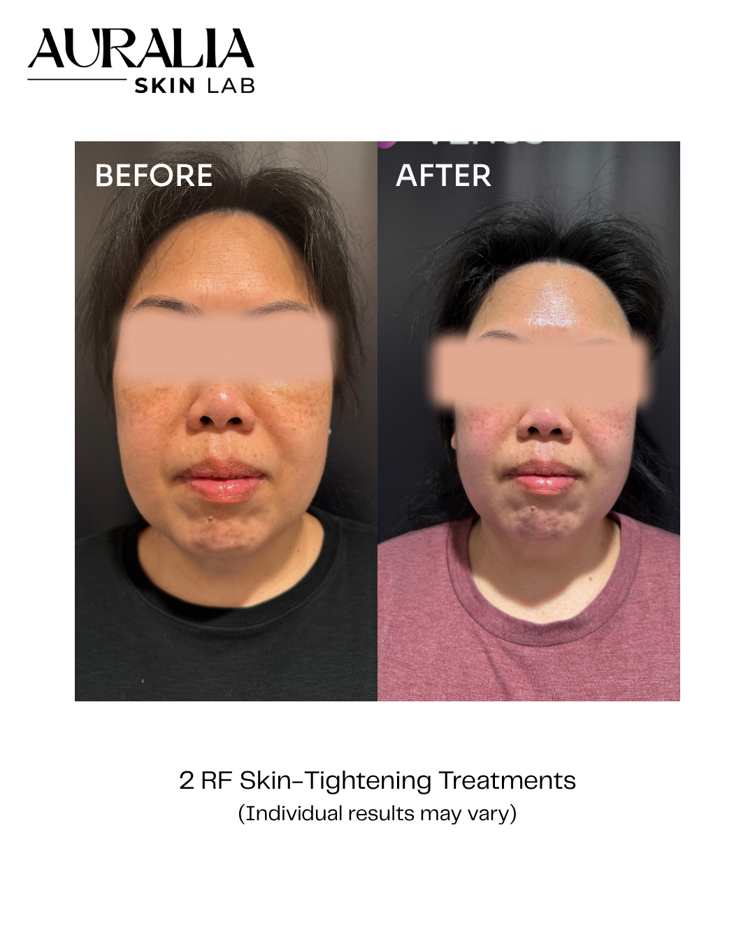 before and after photo from skin tightening full face treatment