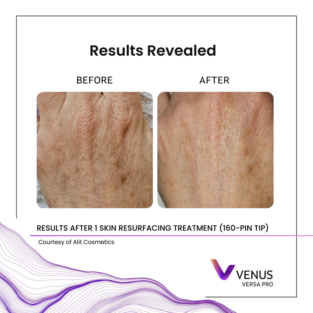 Before and after NanoFractional RF skin resurfacing for uneven skin texture