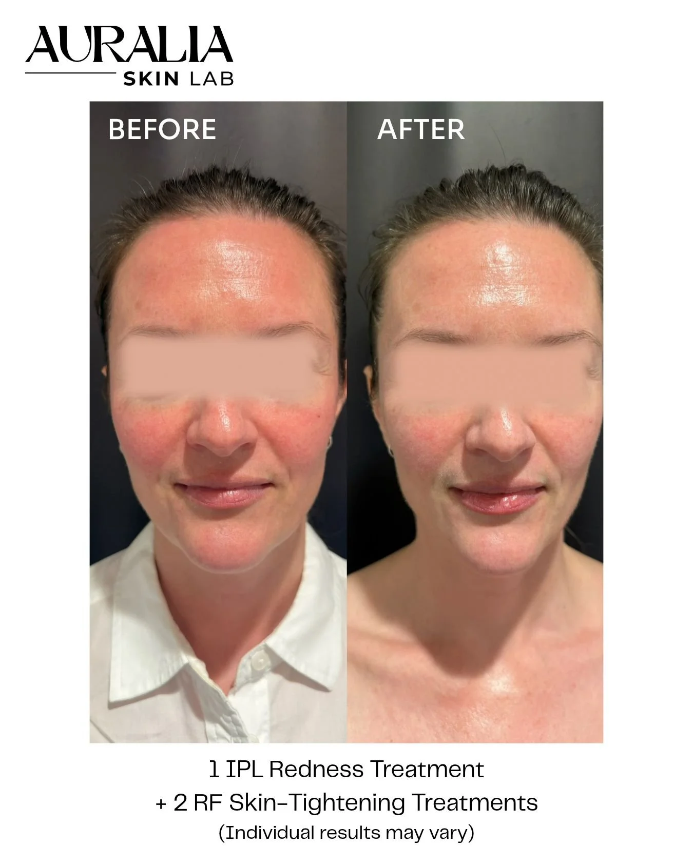 Results from skin tightening full face treatment
