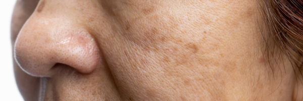 Erasing Summer Skin Damage: Restore Your Glow This Fall