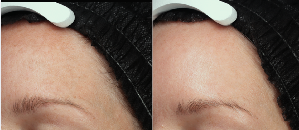 After 3 MOXI Treatments