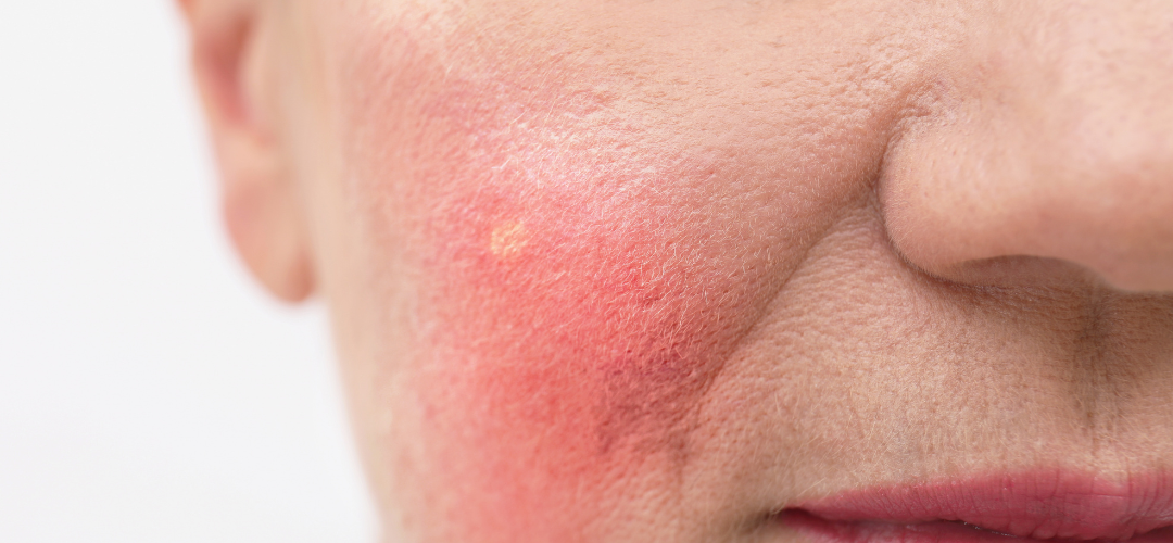 How to Address Facial Redness