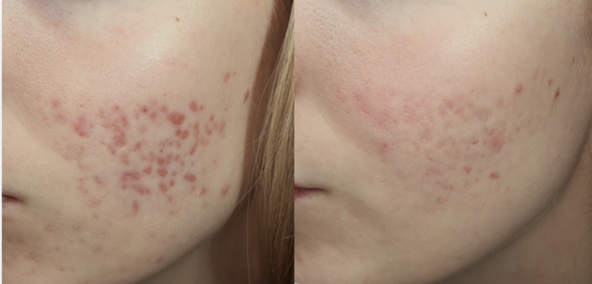 After 2 VI Peels + 1 SkinPen Treatment