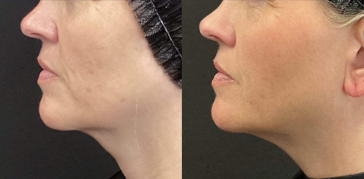 After 2 Everesse Treatments