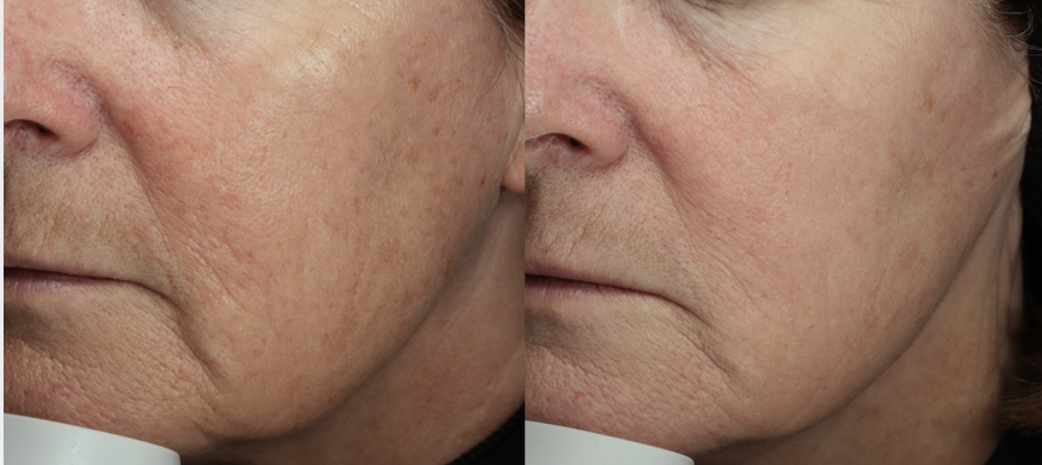 After 3 Helix Fusion Treatments