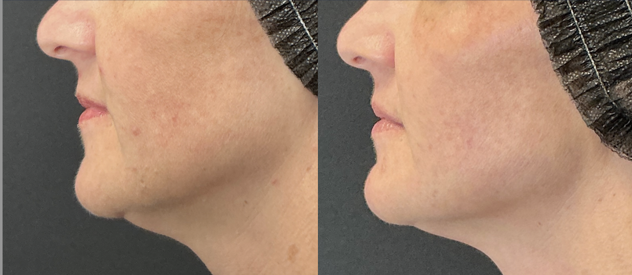 After 2 Everesse Treatments + 3 vials of Sculptra