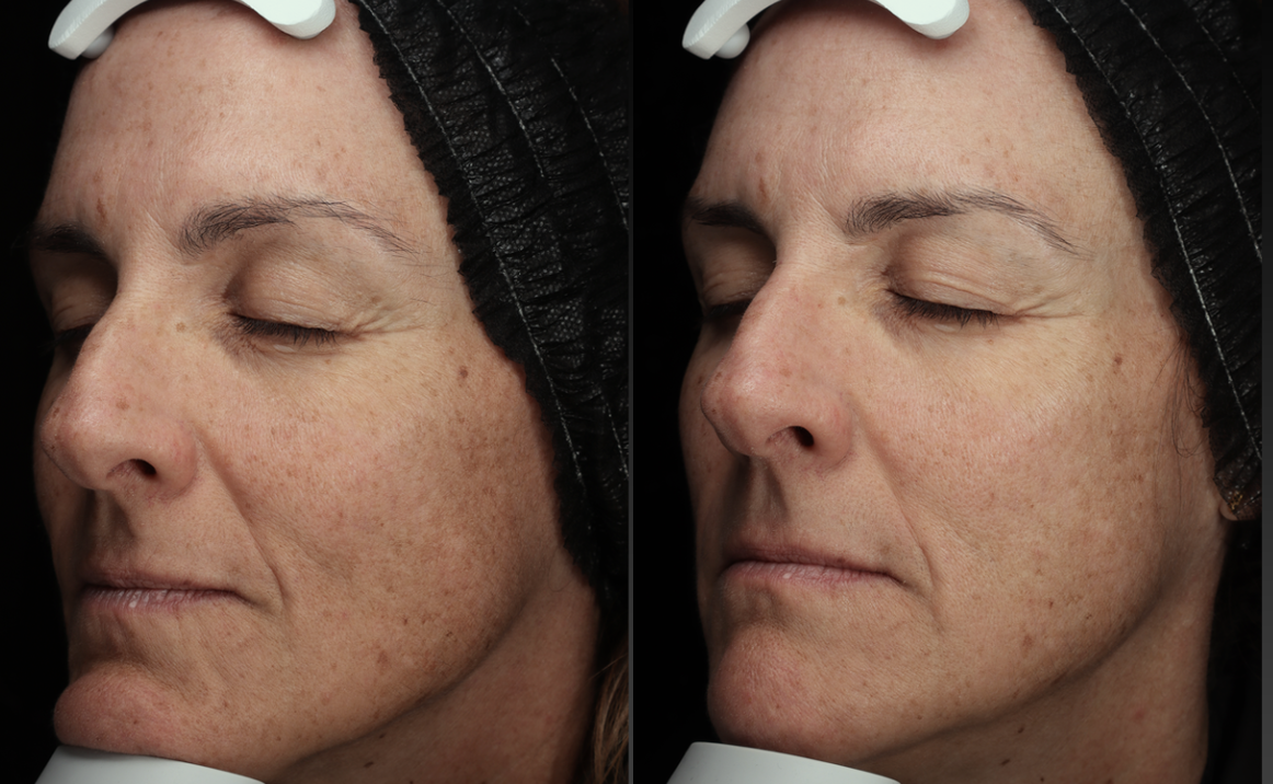 After 3 CoolPeel Treatments