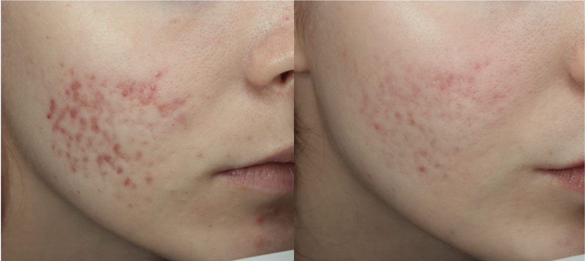 After 2 VI Peels + 1 SkinPen Treatment