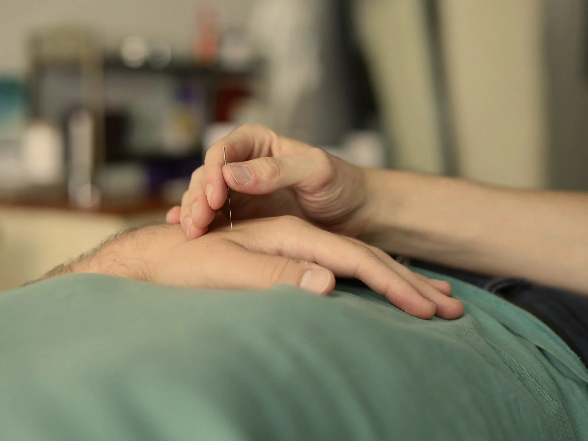 A person receiving an acupuncture treatment with a thin needle inserted into their hand, in a clinical setting.