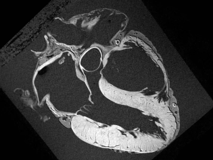 Cardiac MRI