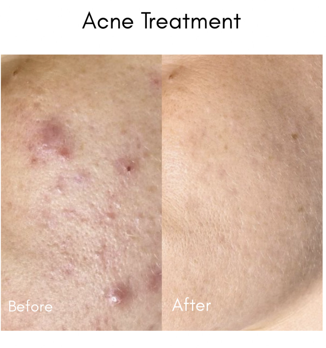 Before and after acne treatment results at Helalat Clinic in Amman
