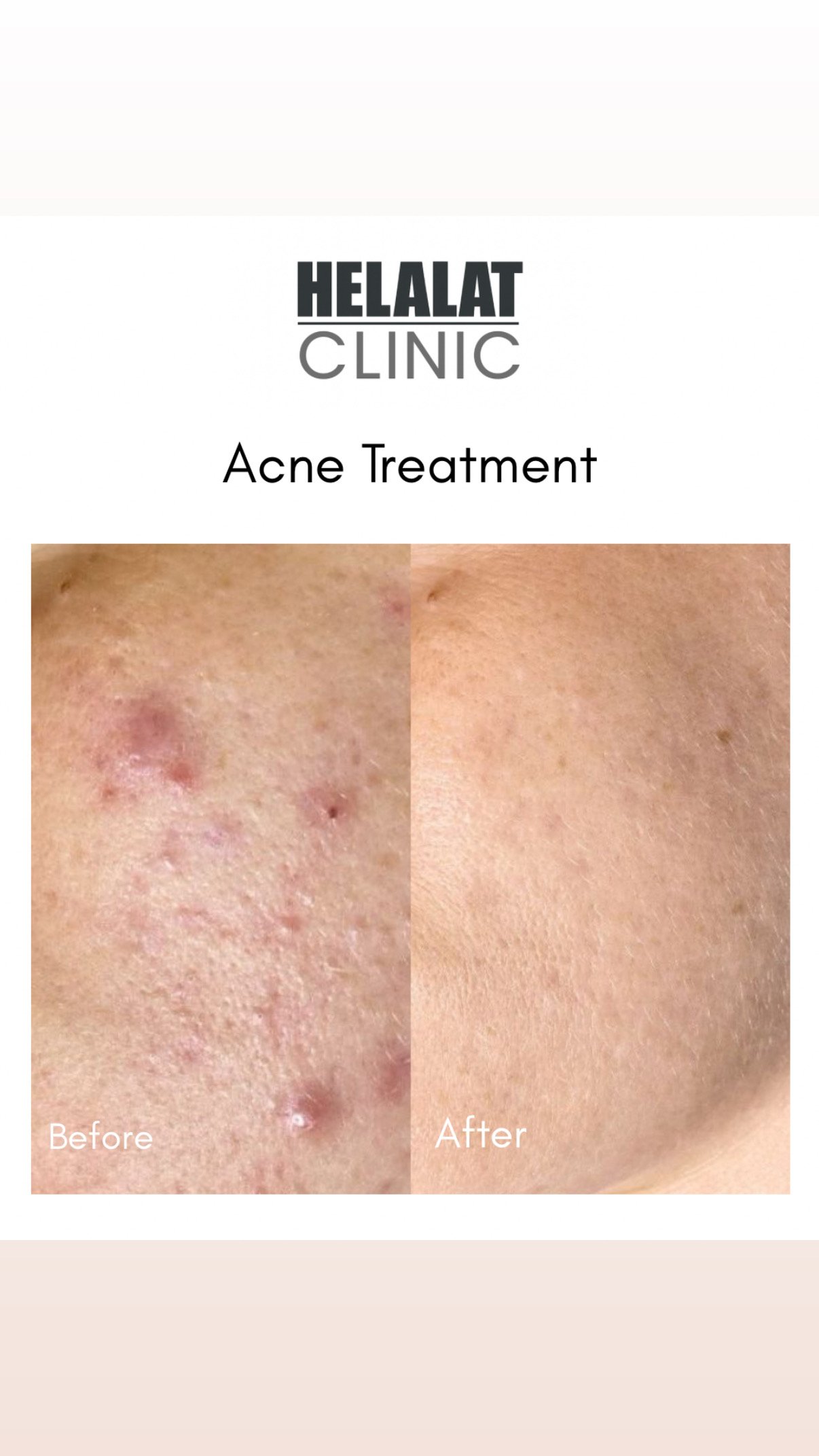 Before and after results of acne treatment at Helalat Clinic in Amman