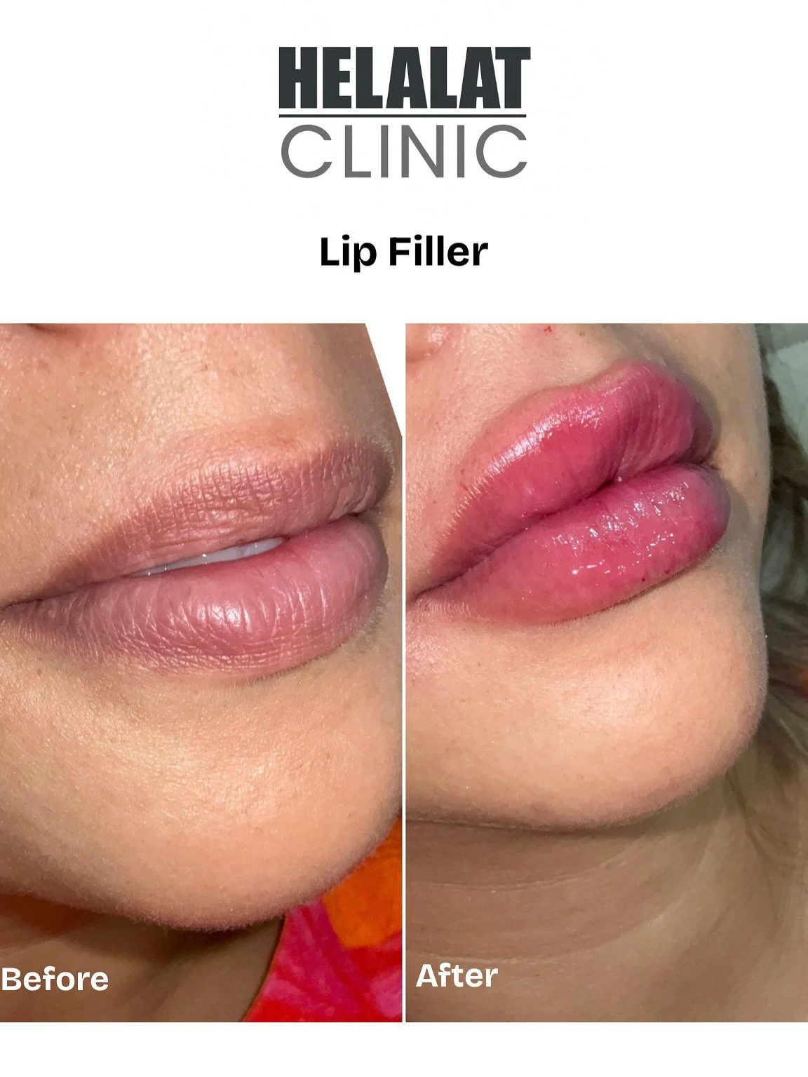 Before and after lip filler results at Helalat Clinic in Amman