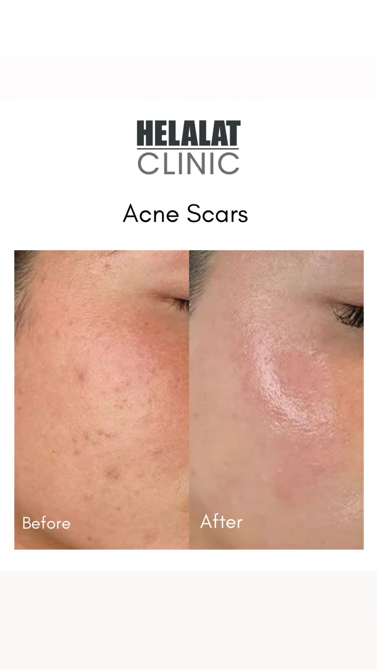 Before and after forehead acne scar improvement at Helalat Clinic in Amman