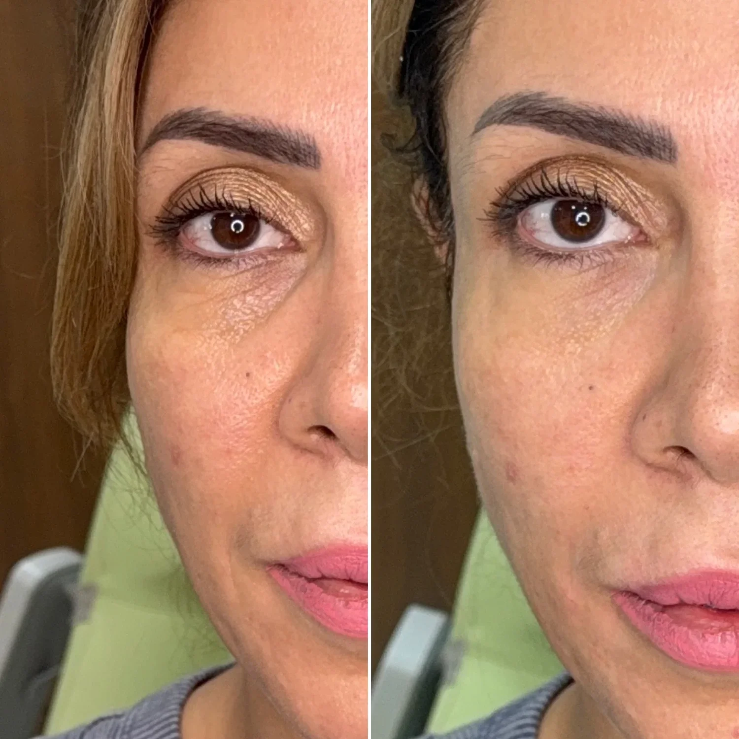 Before and after photo of hyaluronic acid skin booster treatment at Helalat Clinic in Amman, showing improved skin hydration and reduced fine lines