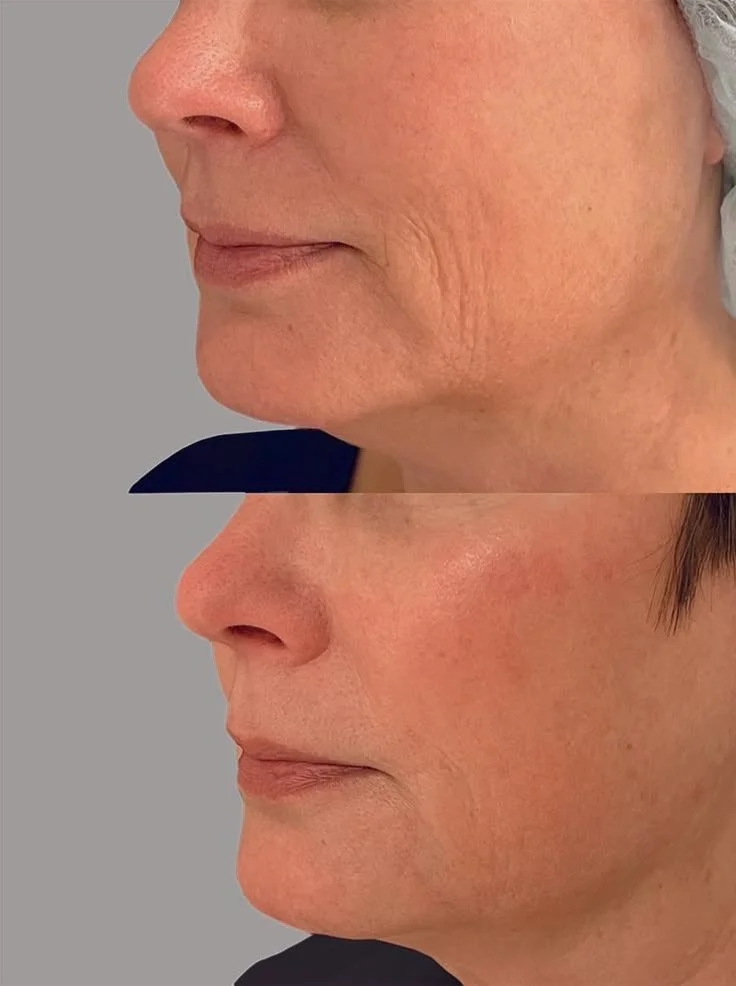 Skin booster injection treatment in Amman at Helalat Clinic